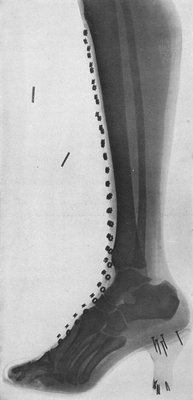 A WONDERFUL X-RAY PHOTOGRAPH